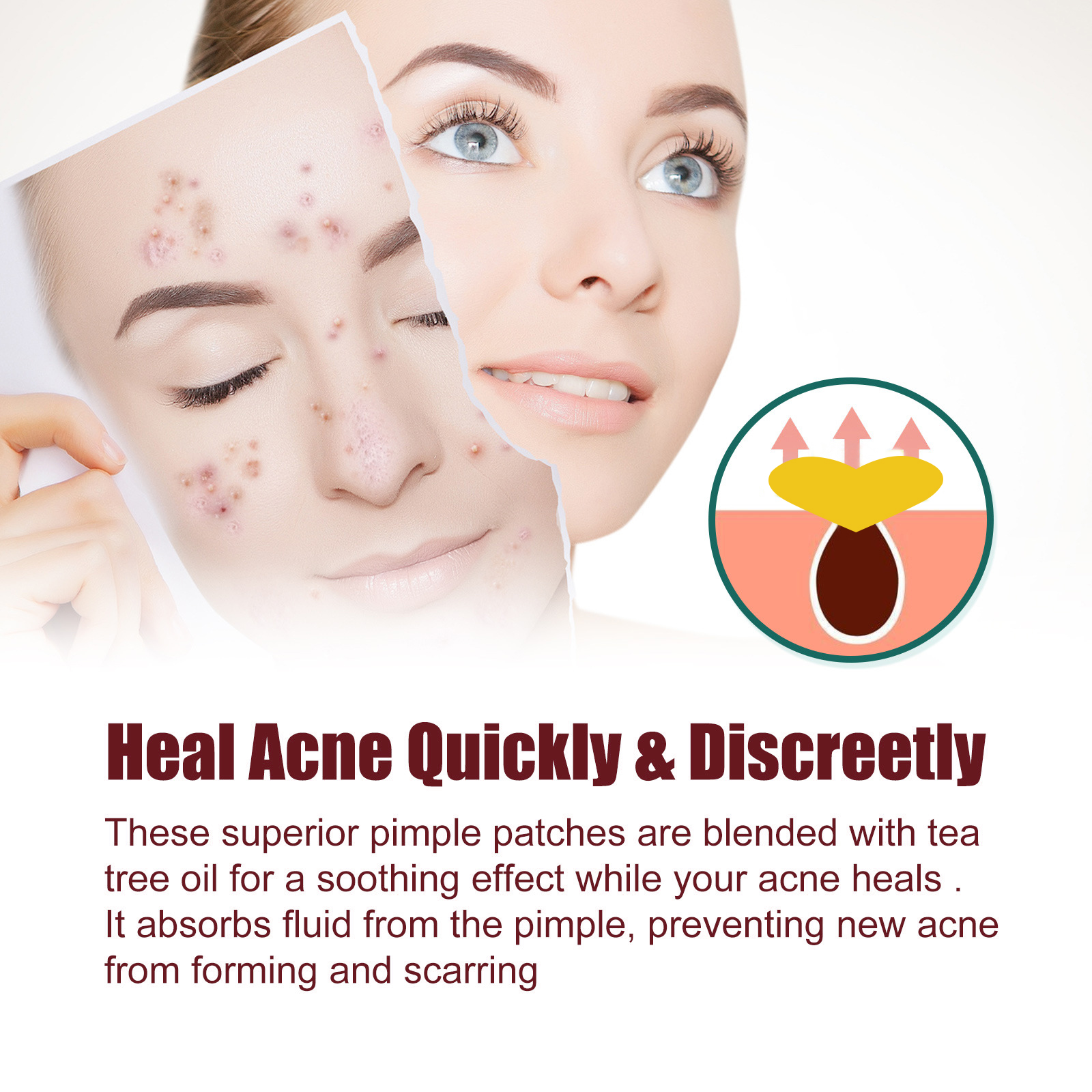 Love Acne Patch Stickers with active ingredients for skin care
